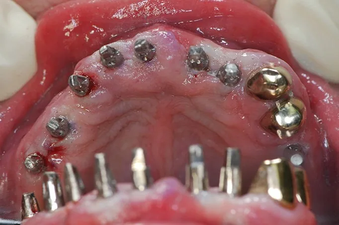 Denti stabili in tempi rapidi con impianti minimamente invasivi - caso storico