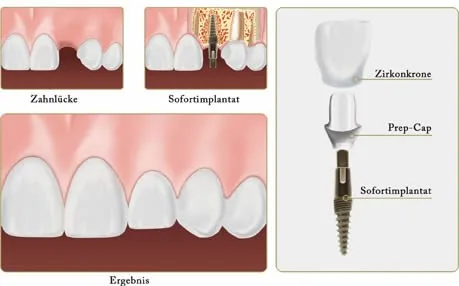 Munich: historical newspaper article on minimally invasive immediate implants Newspaper article on modern minimally invasive immediate-implant techniques