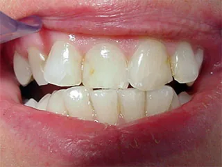 Munich: composite to visually correct minor tooth irregularities