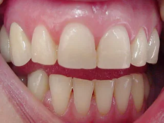 Dentista Monaco: bordi incisali consumati ricostruiti con composito adesivo