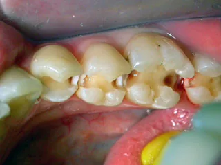 Aesthetic composite fillings for restoring carious teeth: Munich archive