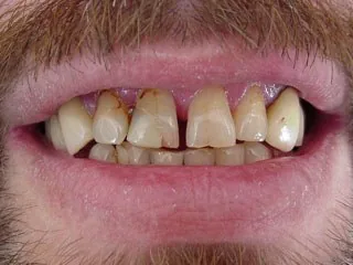 Munich dentist: gap between front teeth closed with composite