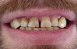 Verschönerung der Zähne mit ästhetischen Füllungen Zahnarzt München Verschönerung der Zähne mit ästhetischen Füllungen Zahnarzt München