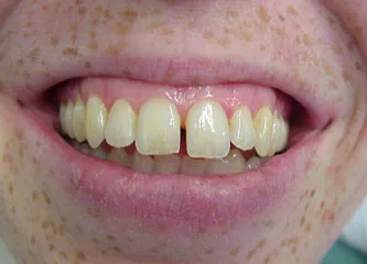 Munich dentist: gap between front teeth closed with composite