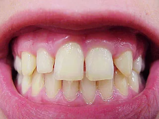 Munich: minor aesthetic dental corrections can improve satisfaction with a smile