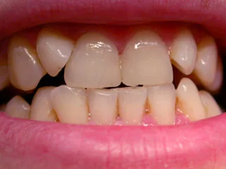 Minor malpositions or teeth that are too small can sometimes be corrected with aesthetic composite restorations.