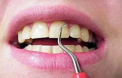 Munich: curettage/debridement to clean below the gum line Munich: curettage/debridement to clean below the gum line