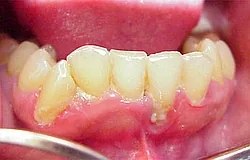 Munich: acute gingivitis with red gums and suppuration Munich: acute gingivitis with red gums and suppuration