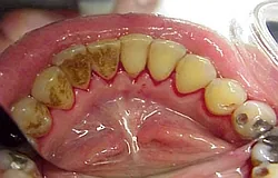 Munich: professional tooth cleaning for unattractive deposits and stains Munich: professional tooth cleaning removes many unattractive deposits from teeth