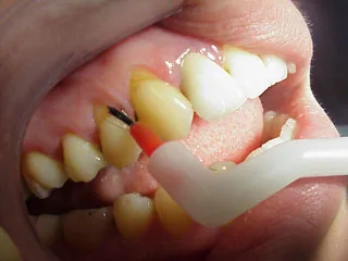 Denti sensibili al freddo: cause e possibilità di trattamento