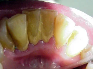 Ultrasonic tartar removal: frequency and prevention