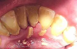 Munich: ultrasonic tartar removal Munich: ultrasonic tartar removal