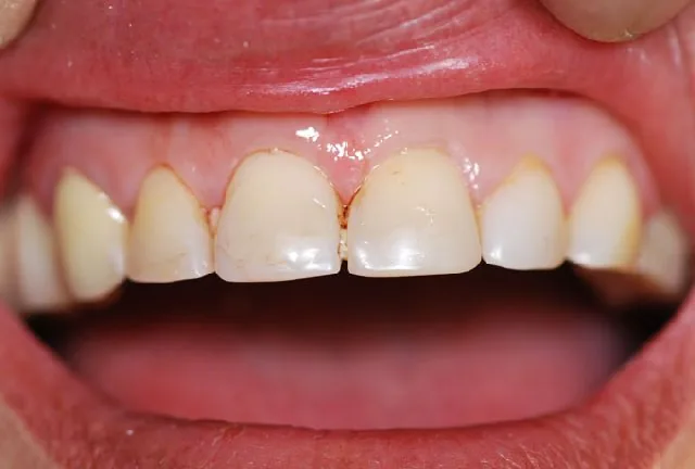 Dentista Monaco: faccetta in vetroceramica e allungamento degli incisivi