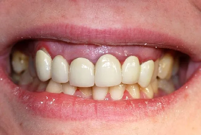 Munich dental archive: gummy smile and excessive gingival display