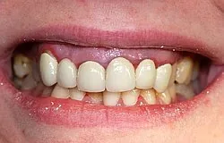 Dentista Monaco: sorriso gengivale e gengiva alta