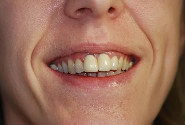Monaco: corone naturali in ceramica e zirconia senza margini metallici