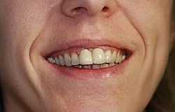 Dentista Monaco: riabilitazione completa della dentatura