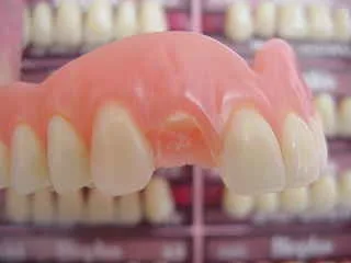 Monaco: dente artificiale staccato dalla protesi - riparazione nel laboratorio storico