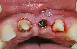 Dentista Monaco: impianto invece di ponte Dentista Monaco: impianto invece di ponte