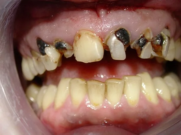 Munich dentist: glass-ceramic veneer and front-tooth lengthening
