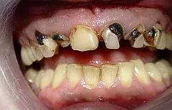 Dentista Monaco: denti di nuovo come nuovi con impianti e corone in zirconia Dentista Monaco: denti di nuovo come nuovi con impianti e corone in zirconia