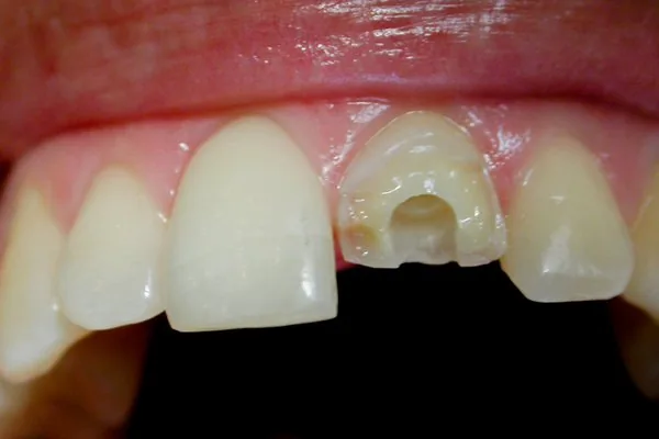 Archivio di Monaco: perno radicolare per un dente fratturato