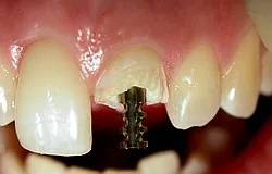Dentista Monaco: un perno radicolare può ricostruire un dente fratturato Dentista Monaco: un perno radicolare può ricostruire un dente fratturato