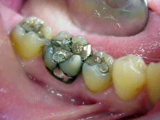 Metal-free zirconia crown, good biocompatibility