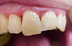 Munich dentist: broken painful tooth, what to do? Munich dentist: broken painful tooth, what to do?