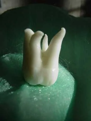 Munich: curved roots are a challenge in root canal treatment