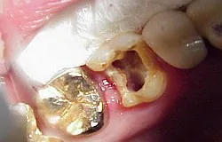 Munich dentist: purpose and principle of root canal treatment Munich dentist: purpose and principle of root canal treatment