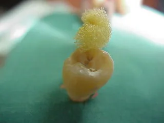 Test di sensibilità: valutare se la polpa dentale risponde ancora agli stimoli