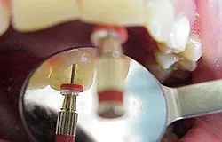 Munich dentist: cleaning and preparation of the root canal Munich dentist: cleaning and preparation of the root canal