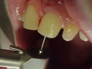 Trattamento canalare: una possibile terapia per dolore derivante dalla polpa o da infezioni endodontiche