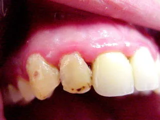 Plaque and deposits promote gum inflammation; good hygiene helps prevent it.