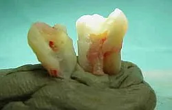 Munich dentist: how toothache develops - dental nerve Munich dentist: how toothache develops - dental nerve